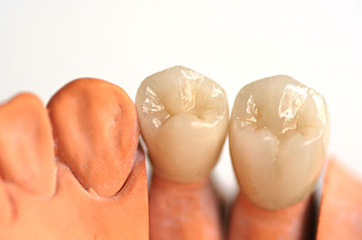 Dental Crowns in Marshall IL