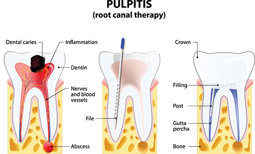 Root Canal Treatment Marshall IL