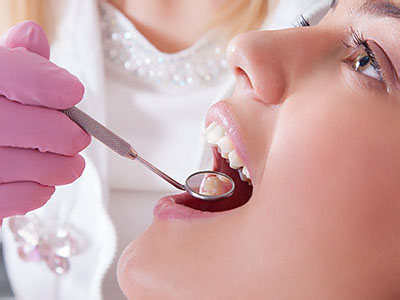 Marshall IL Dental Fillings